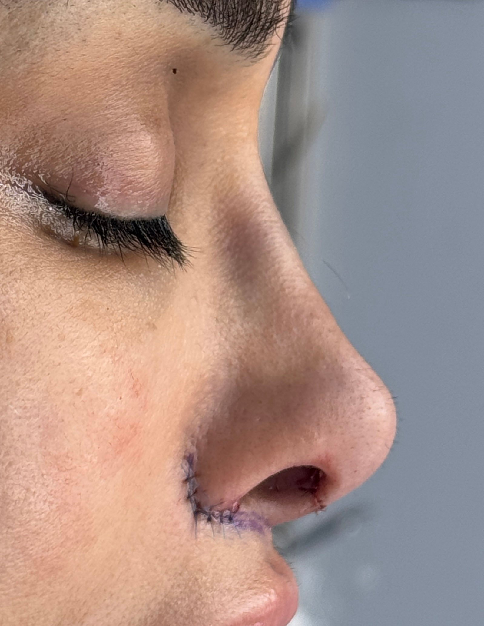 Rhinoplasty – plastic surgery in South Korea